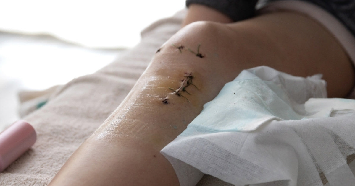 Recovery After Surgery: Simple Ways to Improve Healing